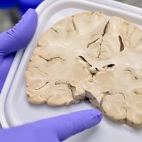 Hallan en Biobanco de la UNAM dos proteínas que se modifican con el Alzheimer