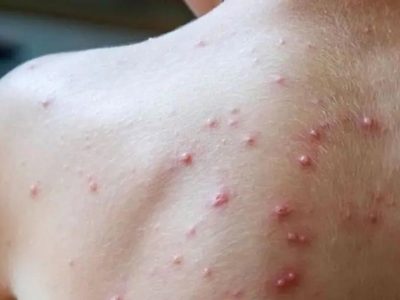 Confirmaron el primer caso de Viruela Símica en Neuquén