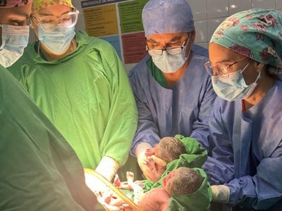 Nacieron trigemelas en Salta: un caso que sucede cada un millón