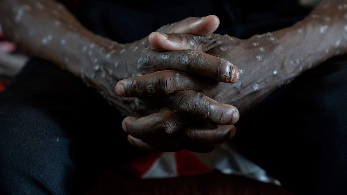 Un hombre con mpox espera recibir tratamiento en el Hospital General de Kamituga en Kivu Sur, República Democrática del Congo, el 4 de septiembre del 2024