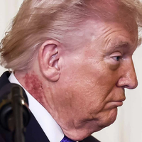 ¿Qué es esa erupción en el cuello de Trump?