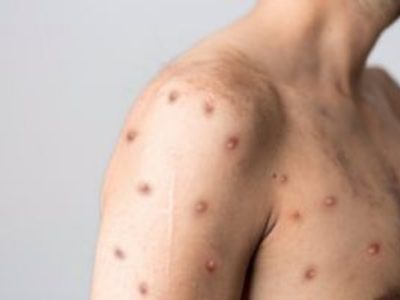 La OMS registra más de 26 mil casos de mpox en la primera mitad del año, la mayoría en África