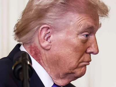 ¿Qué es esa erupción en el cuello de Trump?