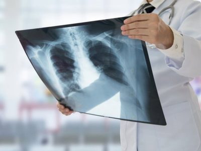 Reumatóloga advierte de que ciertas bacterias o sustancias químicas podrían desencadenar sarcoidosis
