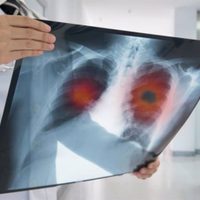 El cáncer de pulmón no microcítico aumentó 16% en los últimos 5 años, según estudio