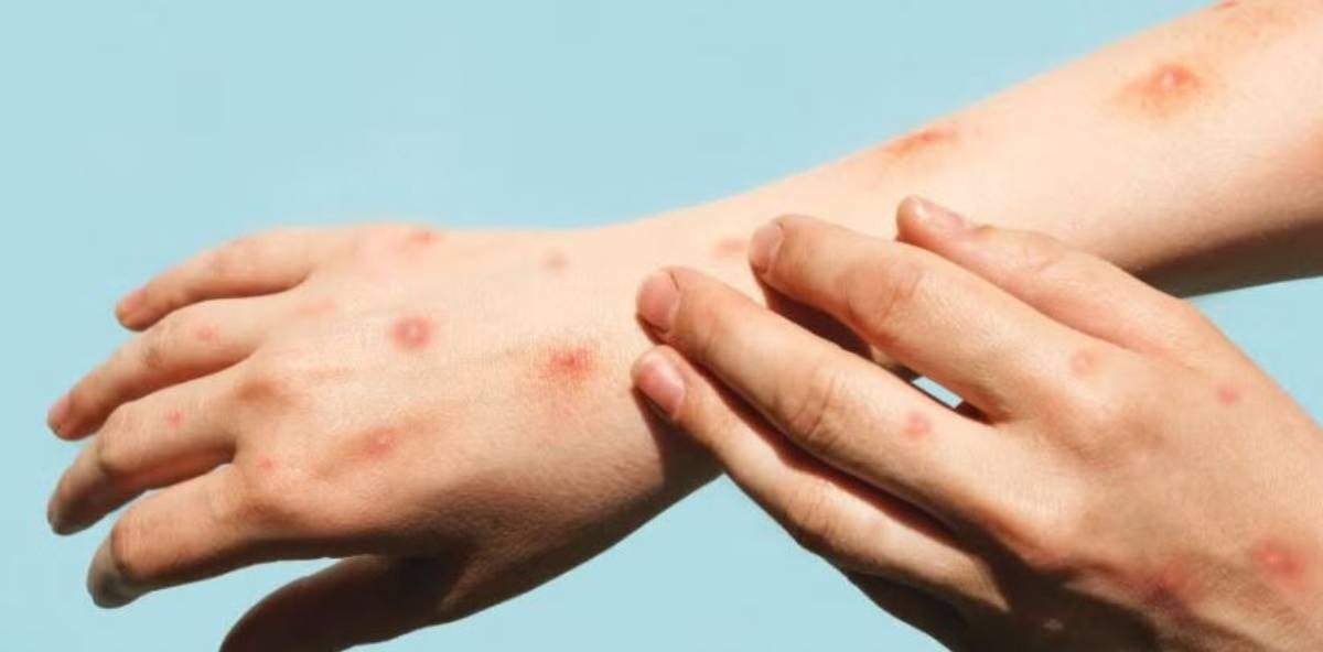 Mpox, antes conocida como viruela símica
