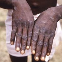 África se declara en emergencia por viruela del mono