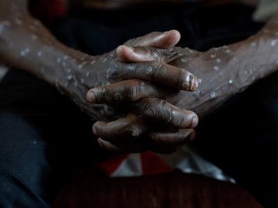 Congo declara fin de brote de mpox, tras dos años y más de 2 mil 200 muertes