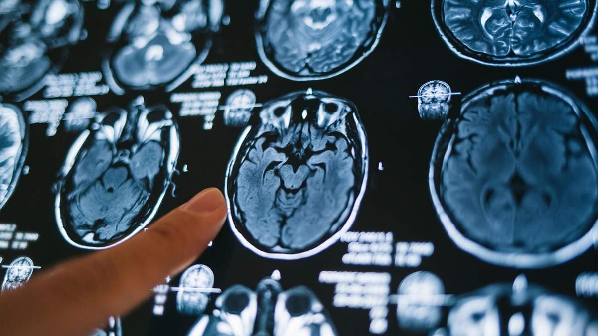Detección de un hematoma subdural. Fuente: (Twitter)