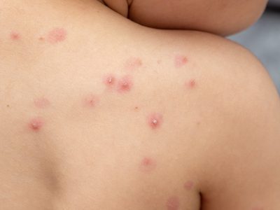 Confirmaron cinco casos de viruela del mono en Mendoza