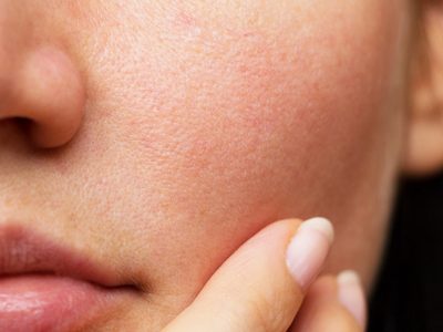 Tu piel merece otra oportunidad: la forma natural de eliminar las manchas más odiosas