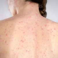 Latinoamérica acechada por las epidemias: México confirmó casos de sarampión