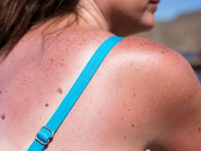 Si vas de vacaciones a la playa: conocé los riesgos de las quemaduras solares y cómo cuidar mejor tu piel