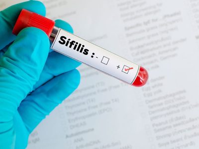 En 2025 se registraron más de 50 mil casos de sífilis en Argentina