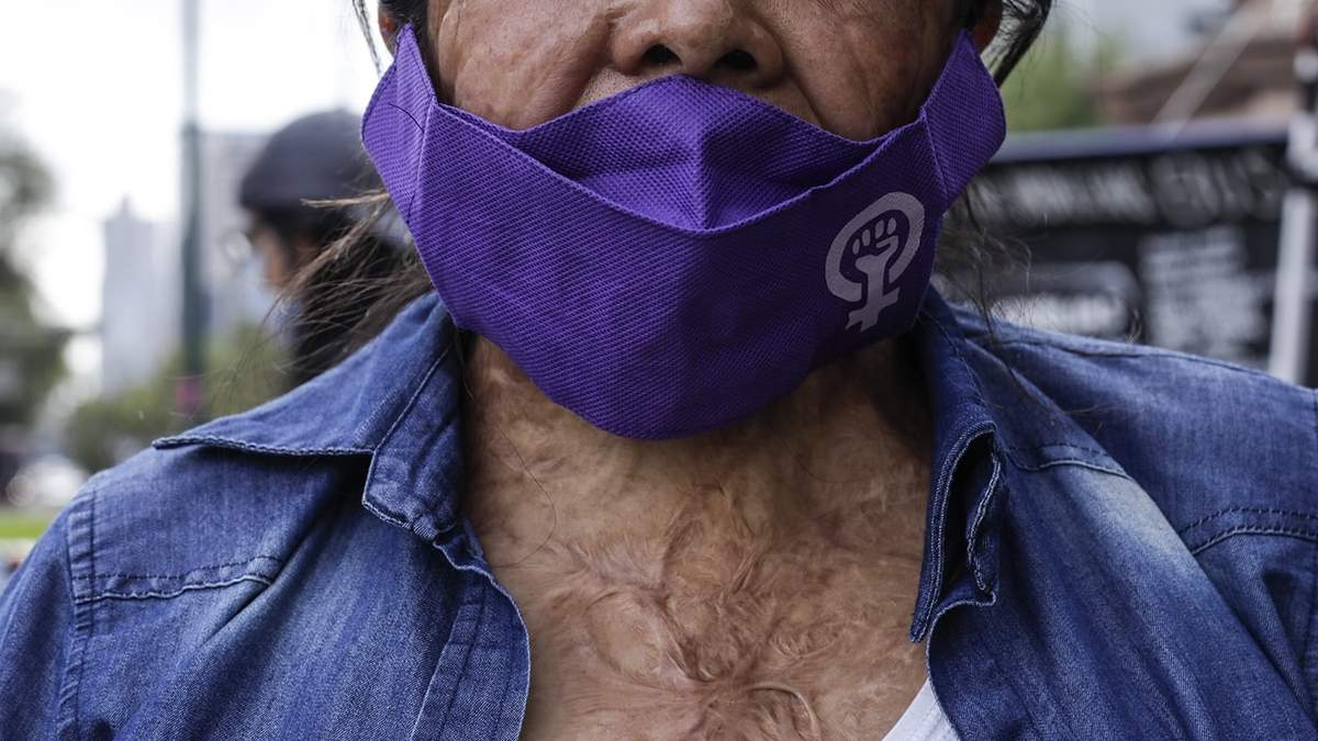 Elisa Xolalpa, víctima sobreviviente a un ataque con ácido
