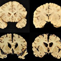 Estudio detecta lesiones en 99% de los cerebros de exjugadores de la NFL