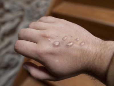 La OMS informa sobre el primer caso de mpox en Malí