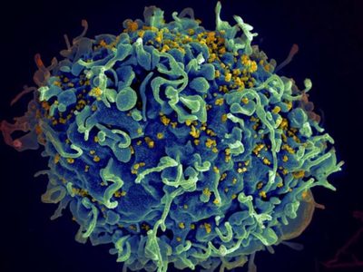 Descubren una variante del VIH más contagiosa y virulenta
