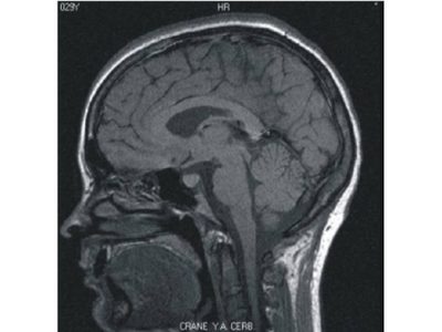 Asocian desarrollo de enfermedades cerebrales con dos químicos habituales en hogares