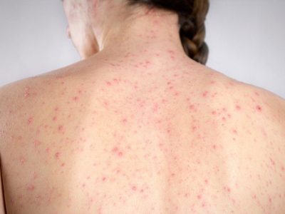 Latinoamérica acechada por las epidemias: México confirmó casos de sarampión