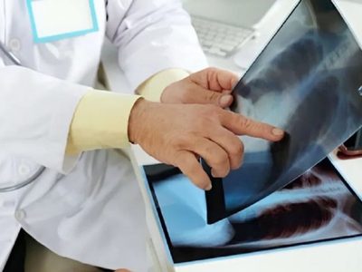 Los casos de tuberculosis en Neuquén se incrementaron un 20 por ciento en los últimos dos años