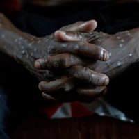 Congo declara fin de brote de mpox, tras dos años y más de 2 mil 200 muertes