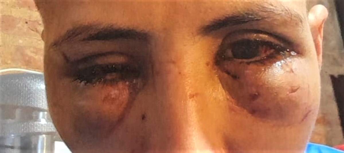 Lesiones en el rostro. Fuente: (Centenario Digital)