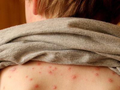 Un niño de 4 años tuvo coronavirus en Italia en noviembre de 2019