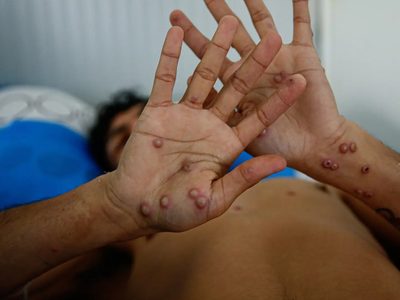 Investigan un posible caso de viruela de mono en Argentina tras la llegada de un buque
