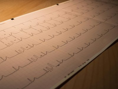 Nueva droga para el tratamiento del infarto de miocardio