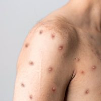OMS añade una segunda vacuna contra la viruela símica (mpox) a la lista de uso de emergencia