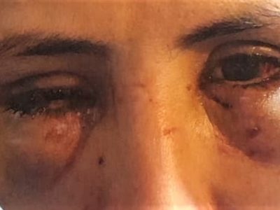 Brutal agresión a una trabajadora municipal: podría perder la visión en un ojo
