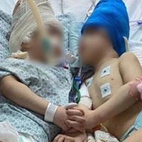 Médicos practicaron con realidad virtual y lograron separar a gemelos unidos por la cabeza