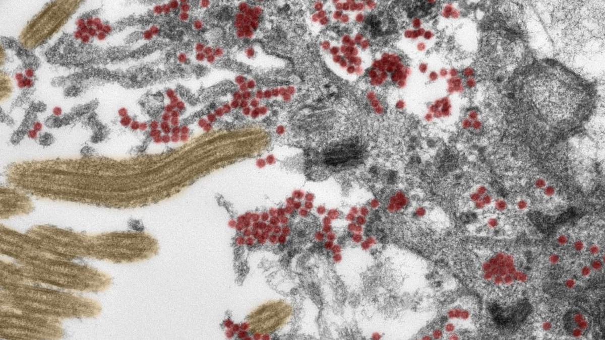 Imagen microscópica de partículas de coronavirus intactas dentro de la mucosa olfativa. Fuente: (Twitter)