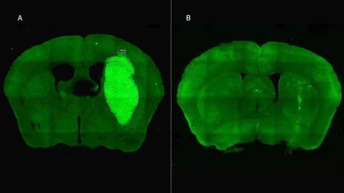 A) Se visualiza el tumor cerebral en un modelo preclínico. B) El tumor desaparece gracias a la administración de la estrategia terapéutica diseñada por los especialistas del CONICET.