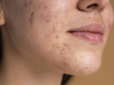Alimentos y hábitos que mejorarán tu piel con acné: querrás saber esto