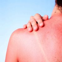 Piel y verano: señales, cambios y síntomas que no deben pasarse por alto