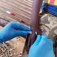 ¿Cuáles son los síntomas de mpox y qué diferencia hay entre las cepas de Mpox?