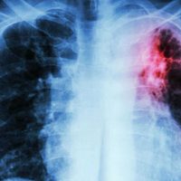Alerta por tuberculosis en Neuquén: ya confirmaron 10 casos en lo que va del 2026