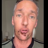 Actor porno comparte su experiencia al contagiarse de viruela del mono: "las lesiones son brutales"