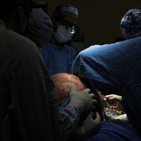 IMSS de Querétaro extirpa tumor ovárico de casi 23 kilogramos a paciente de 37 años (Video)