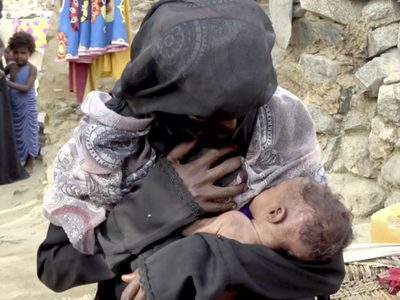 Malnutrición infantil: Nueva arma de guerra