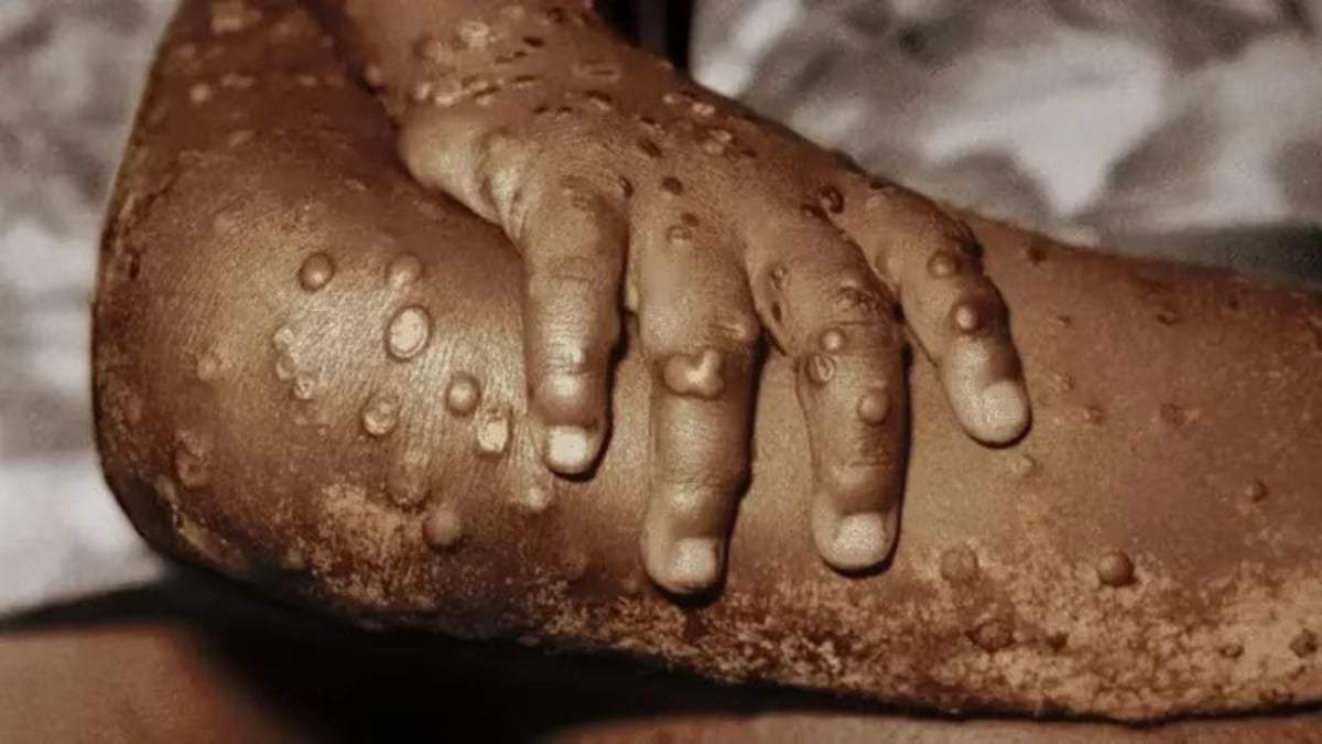 Virus Mpox