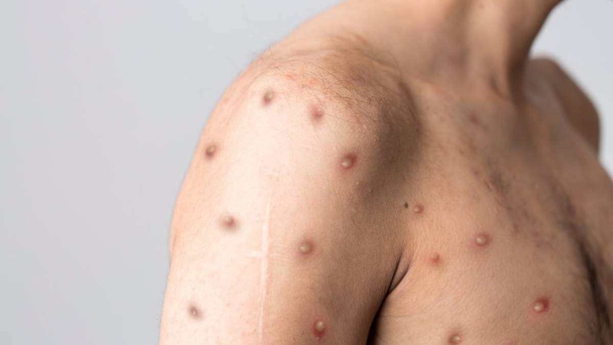 Paciente con mpox
