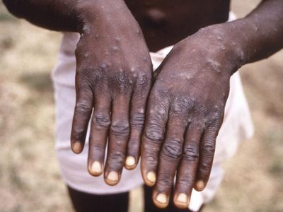 El virus de la viruela del mono se detecta en la saliva y en el semen