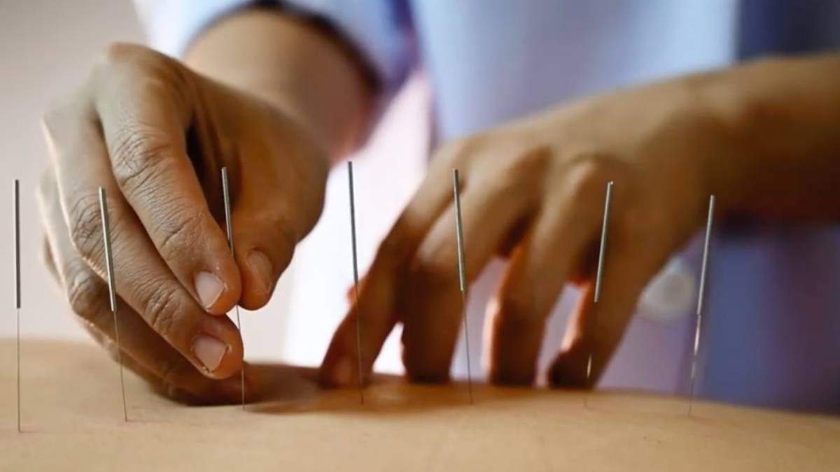 La acupuntura es una de las prácticas antiguas mencionadas por la OMS