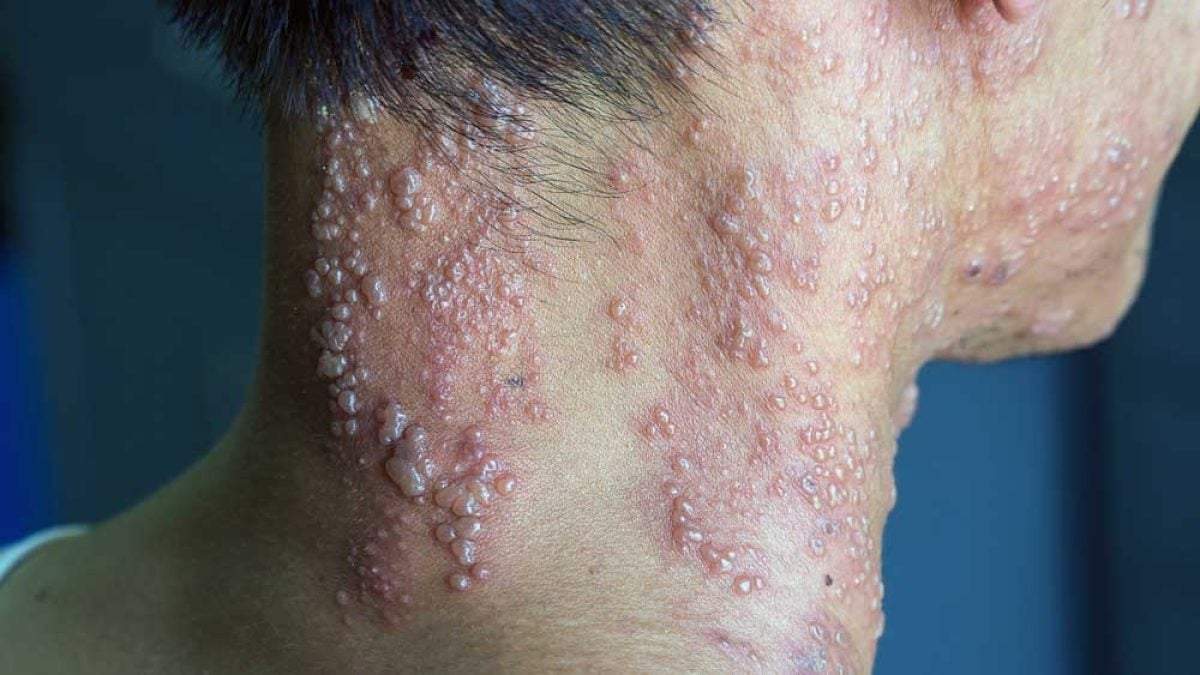 Herpes Zóster en cara y cuello