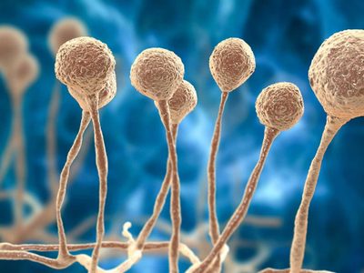 Primer deceso por "hongo negro" en el país: qué es y qué tratamiento tiene la infección