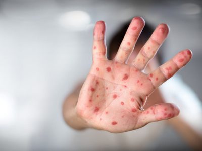 El Ministerio de Salud habló del posible caso de sarampión