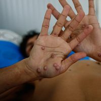 Investigan un posible caso de viruela de mono en Argentina tras la llegada de un buque